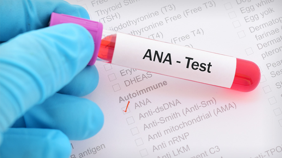 Hand in a latex glove holding a test tube with a red liquid in it. The tube says 'ANA Test'.